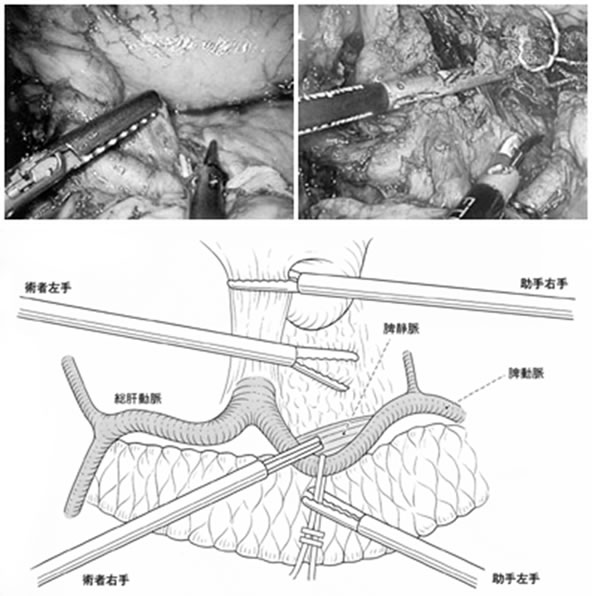 脾静脈を露出させ動静脈間のリンパ節を郭清する（『腹腔鏡下胃切除術』医学書院刊より）