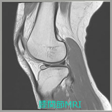 膝関節MRI