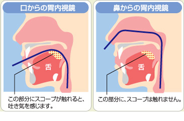 経鼻内視鏡