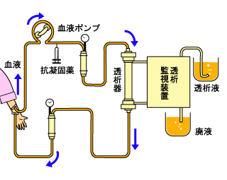 人工透析の仕組み