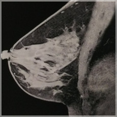 マンモMRI-sag