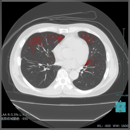 肺解析