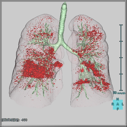 肺解析3D